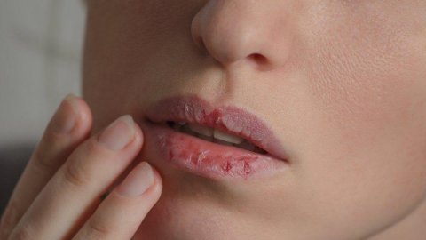 Kışın dudak çatlamasını önlemek için 5 öneri! Mutlaka uygulayın! 