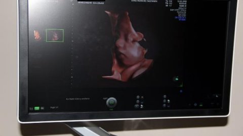 Gebelikte detaylı ultrason doğumsal hastalıkların yüzde 70'ini tespit ediyor